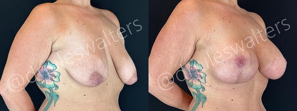 Breast Augmentation Lift Before & After