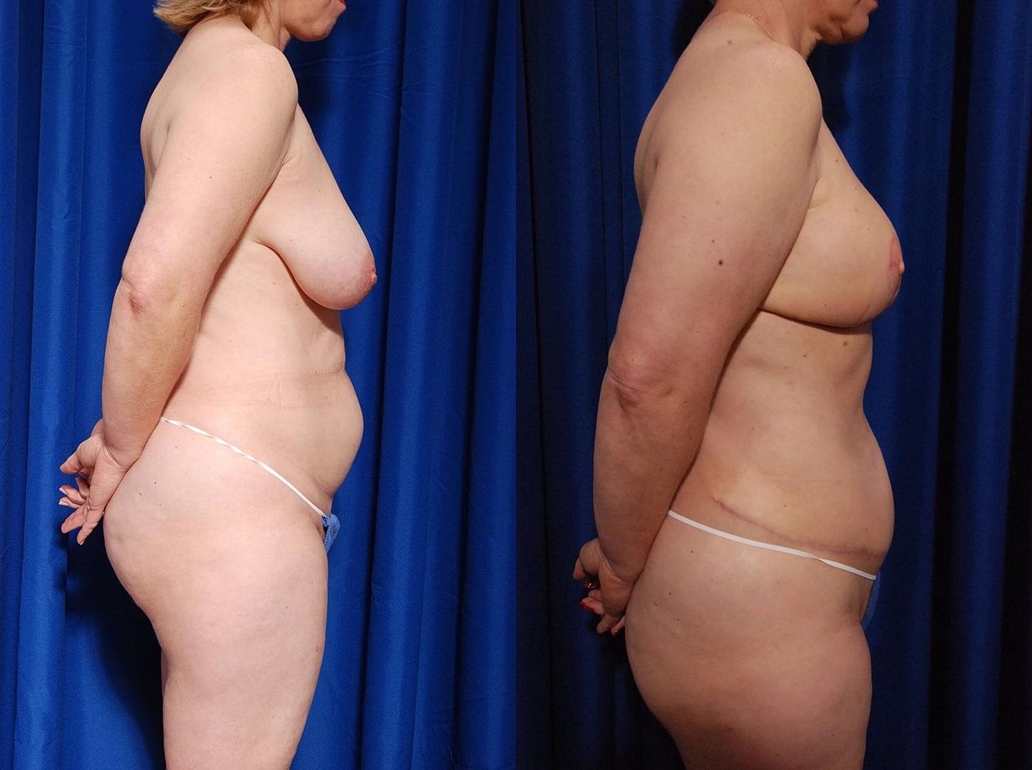 Breast Reconstruction Before & After