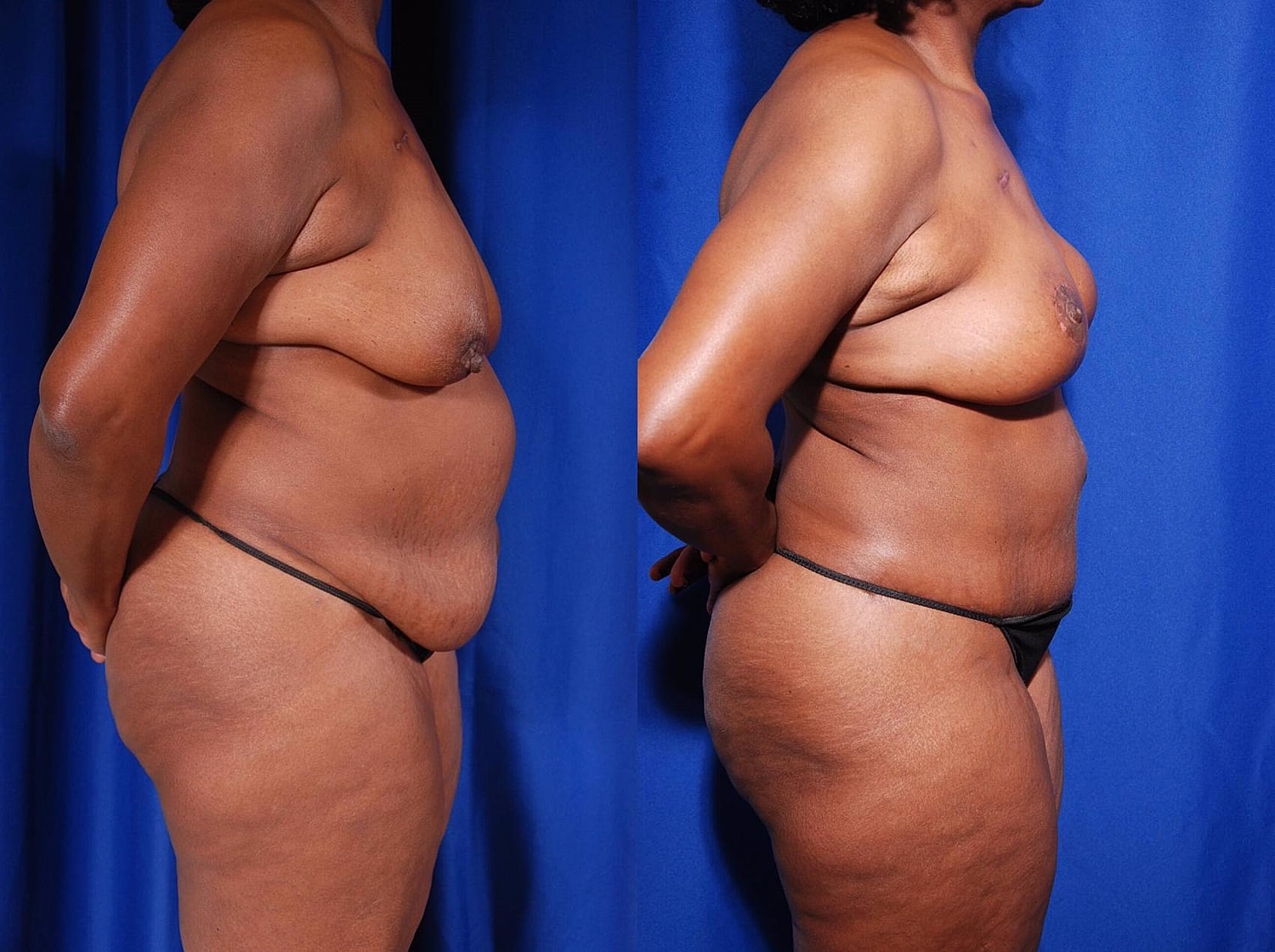 Breast Reconstruction Before & After