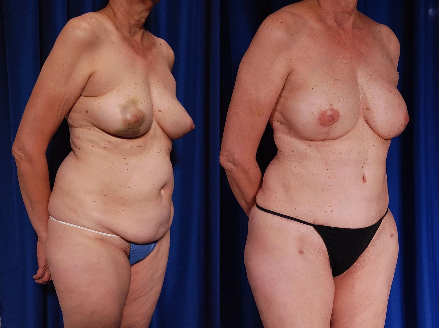 Breast Reconstruction Before & After