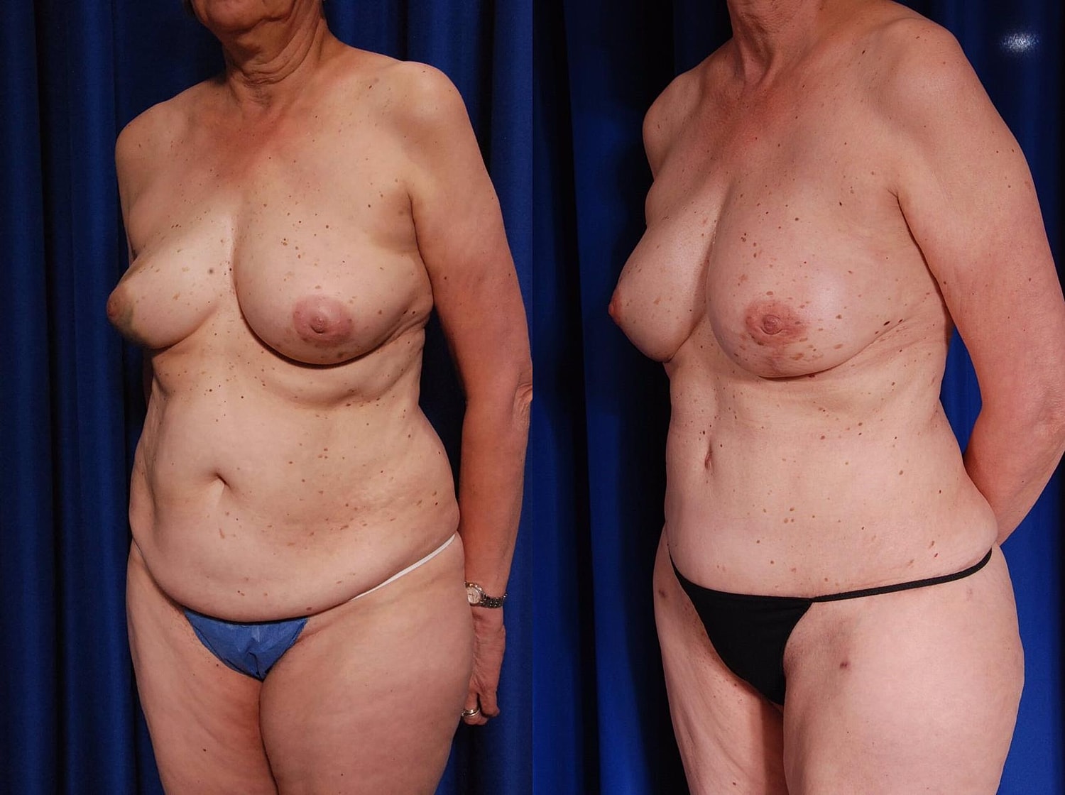 Breast Reconstruction Before & After