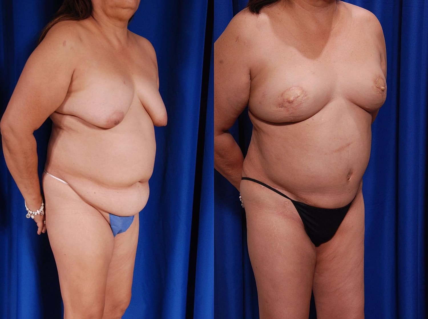 Breast Reconstruction Before & After