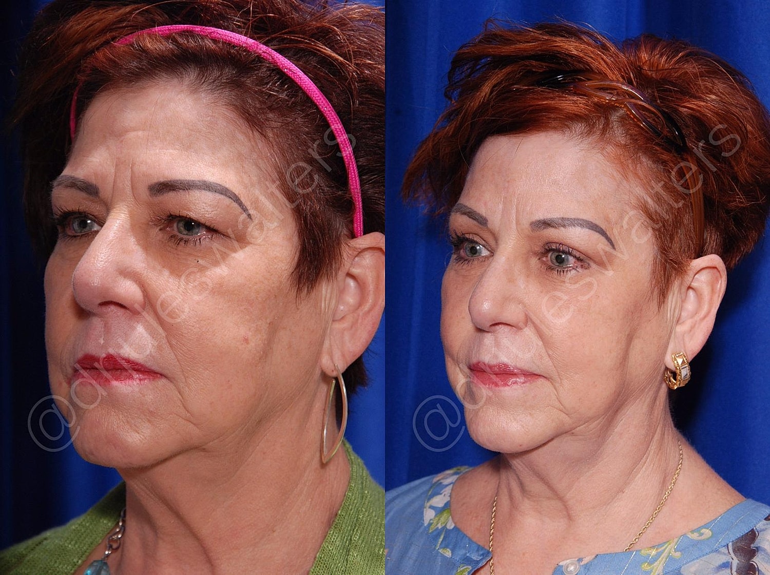 Brow Lift Before & After