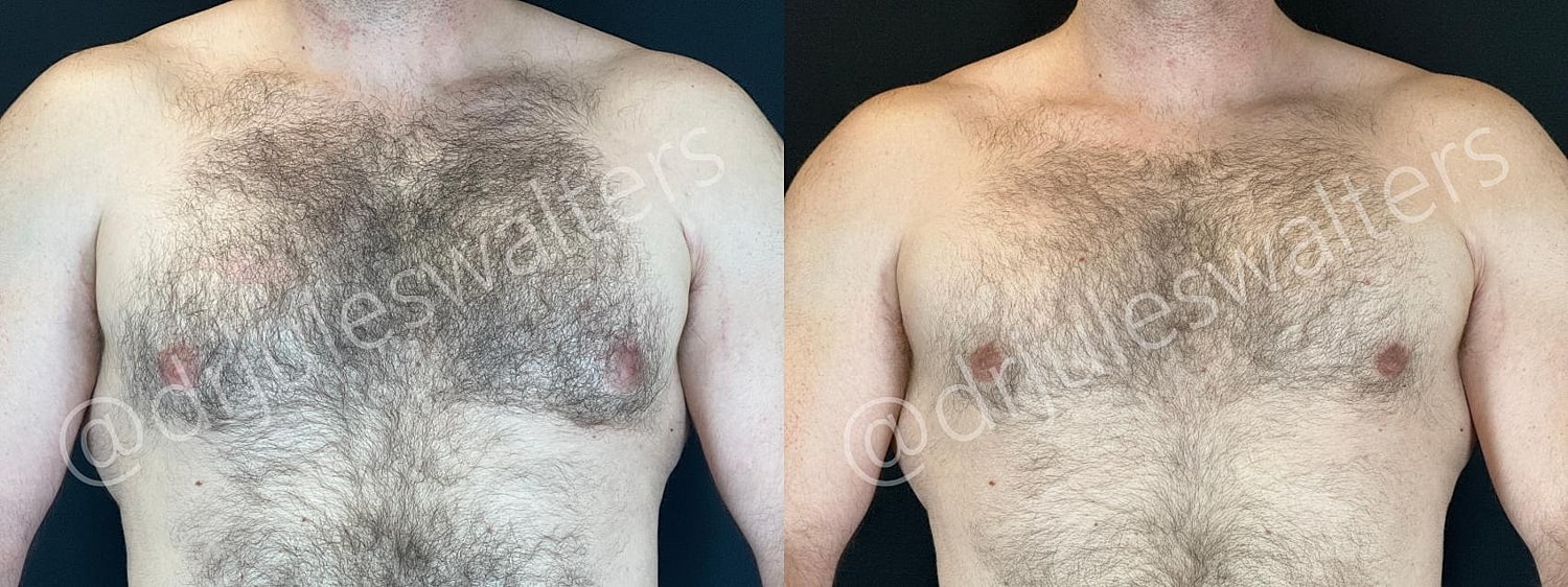 Gynecomastia Before & After