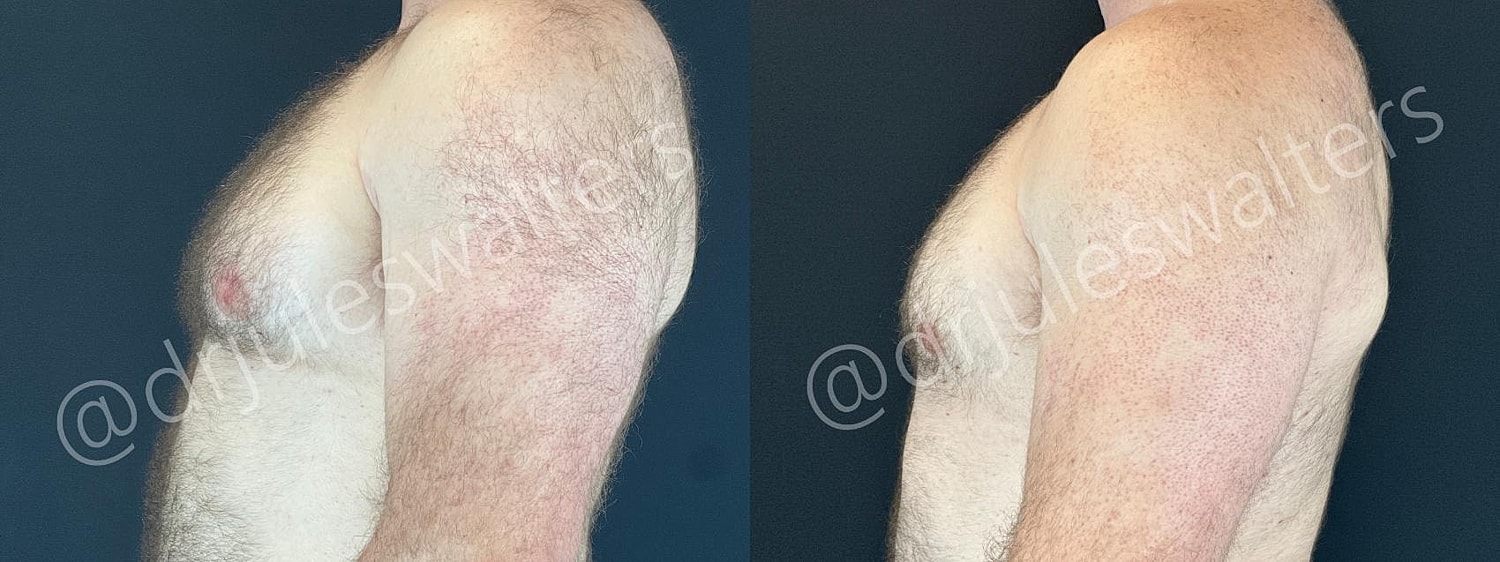 Gynecomastia Before & After