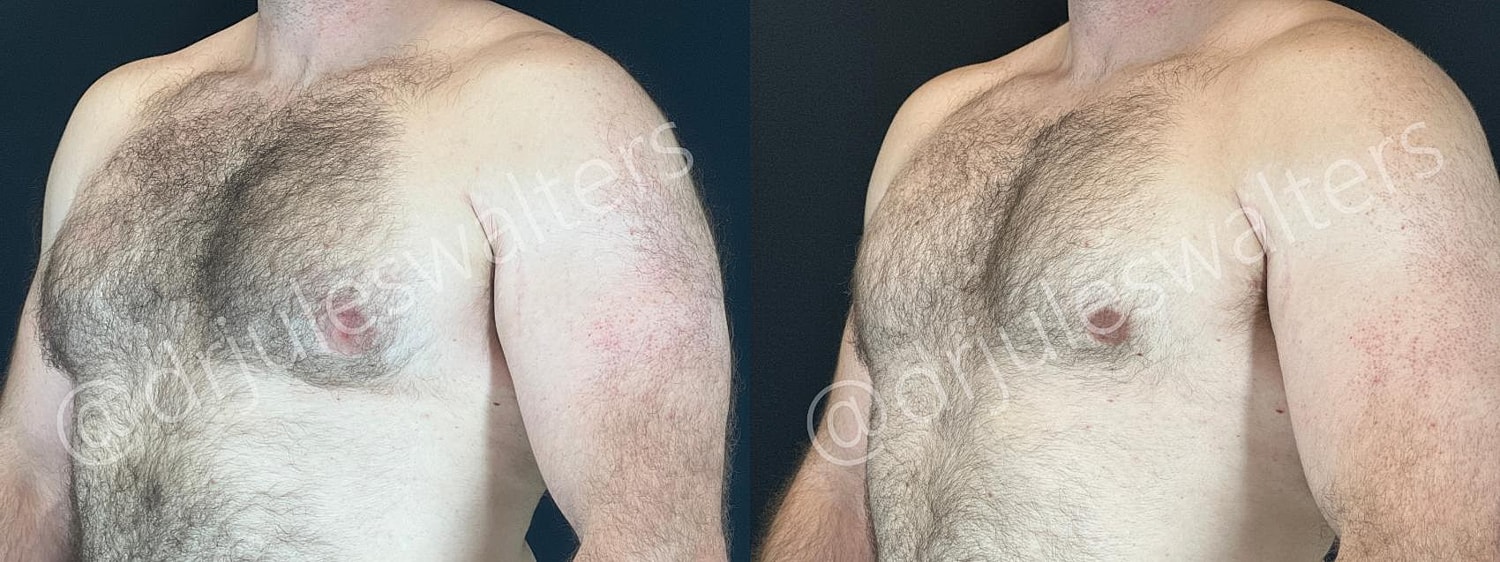 Gynecomastia Before & After