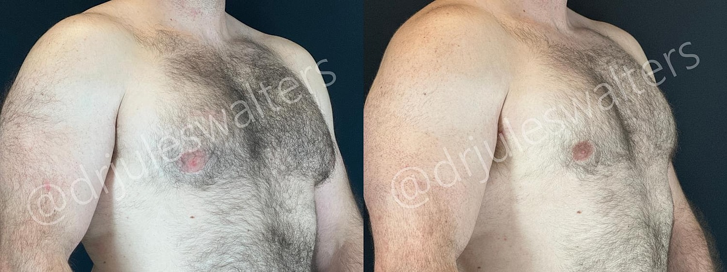 Gynecomastia Before & After