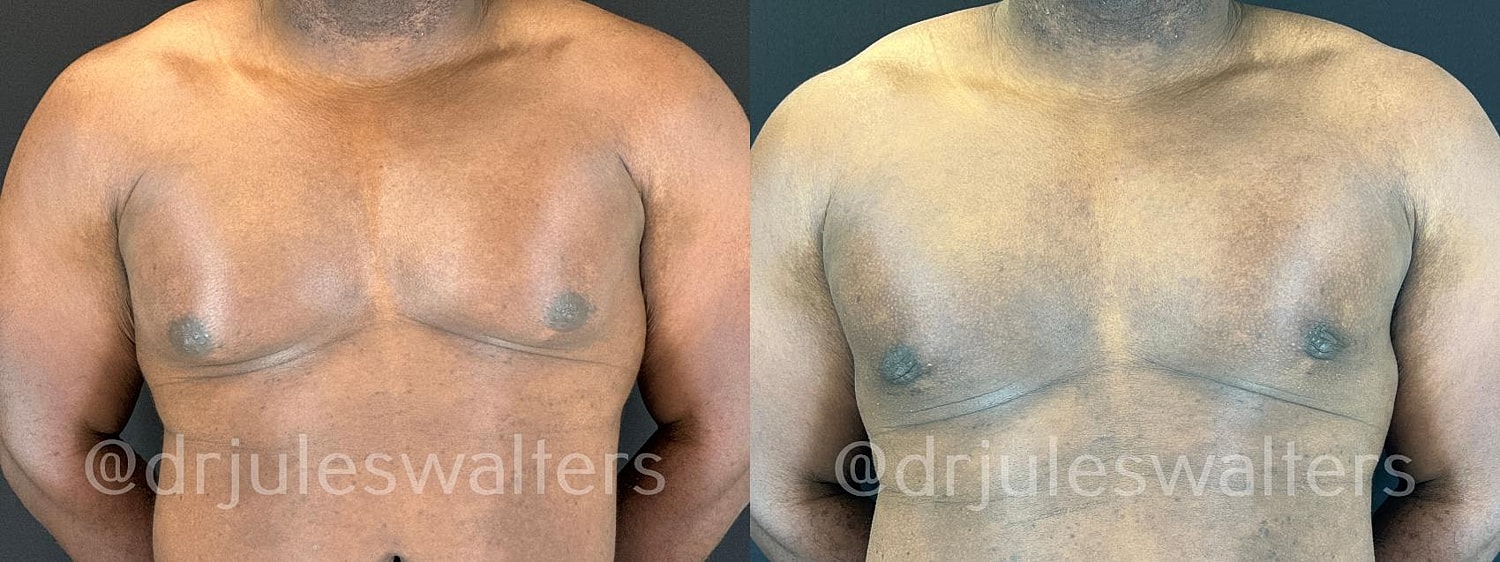 Gynecomastia Before & After