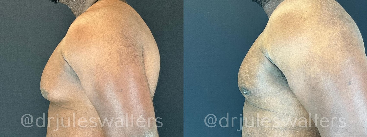Gynecomastia Before & After