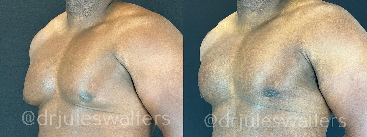 Gynecomastia Before & After