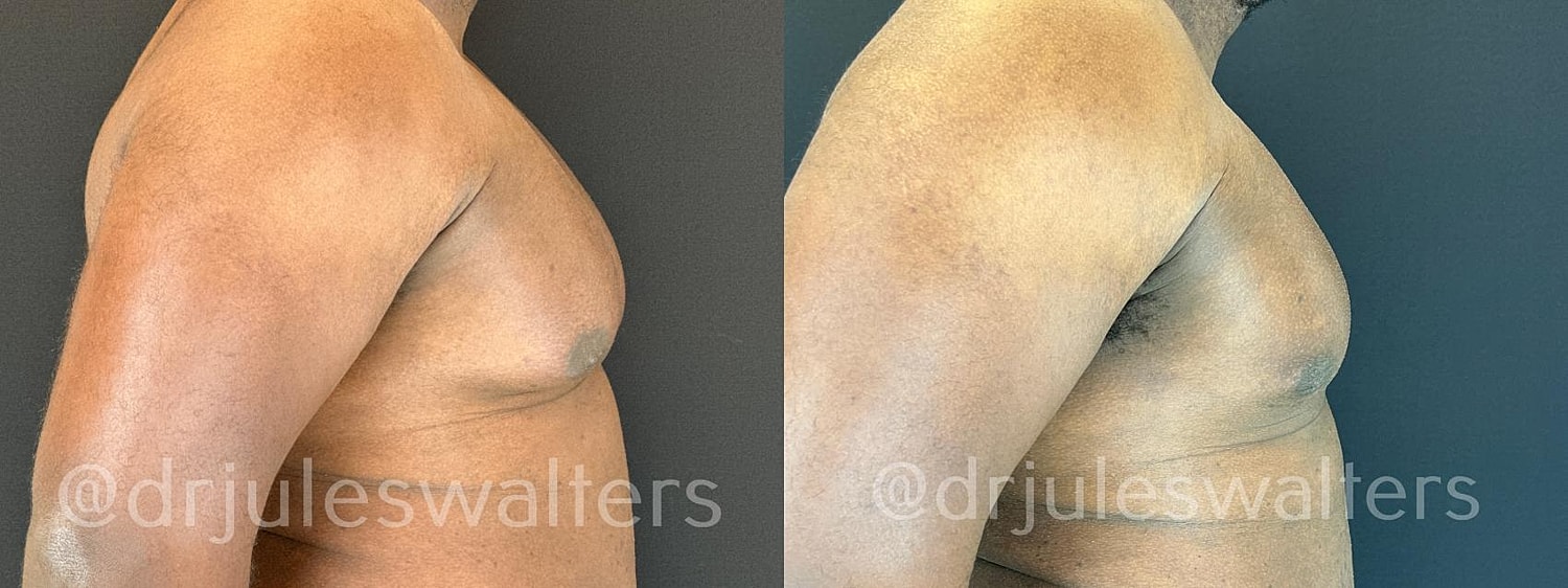 Gynecomastia Before & After