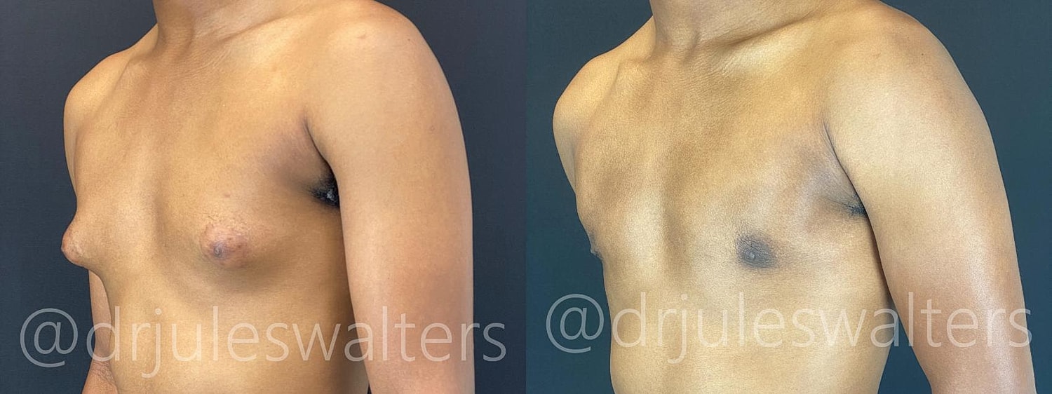 Gynecomastia Before & After