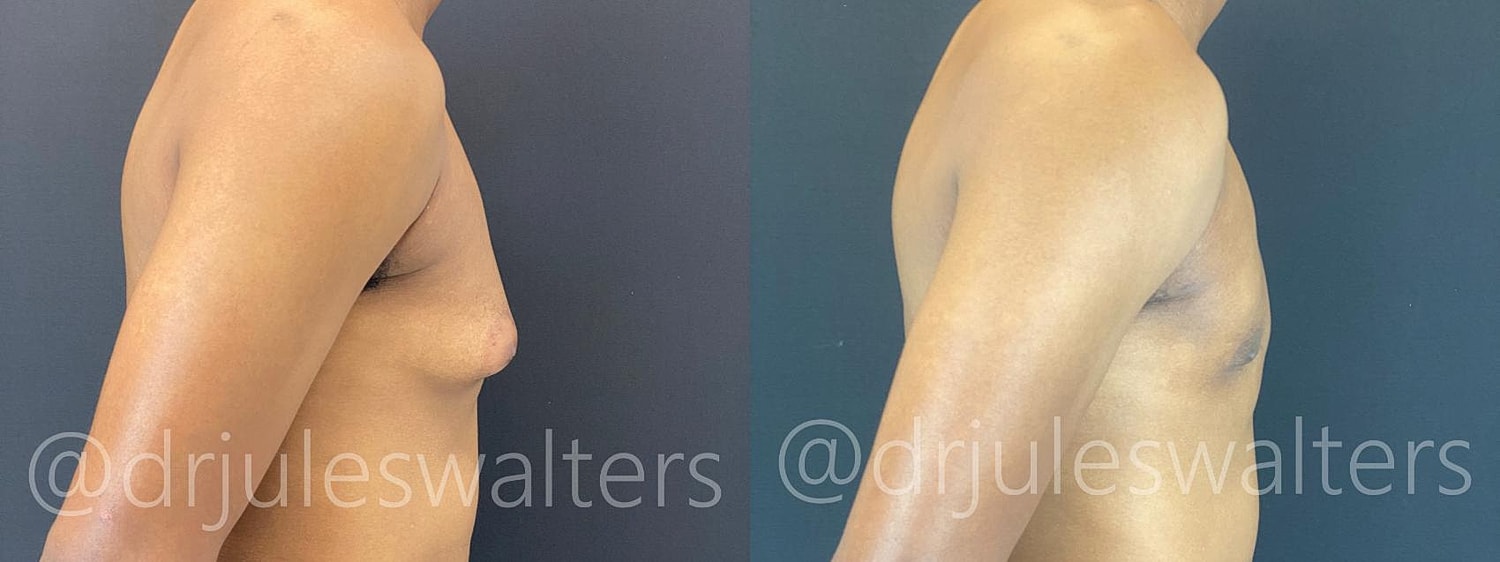 Gynecomastia Before & After