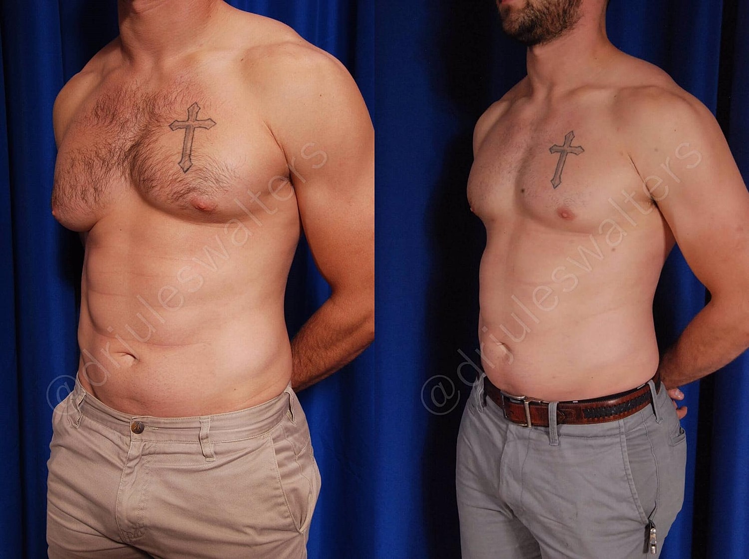 Gynecomastia Before & After