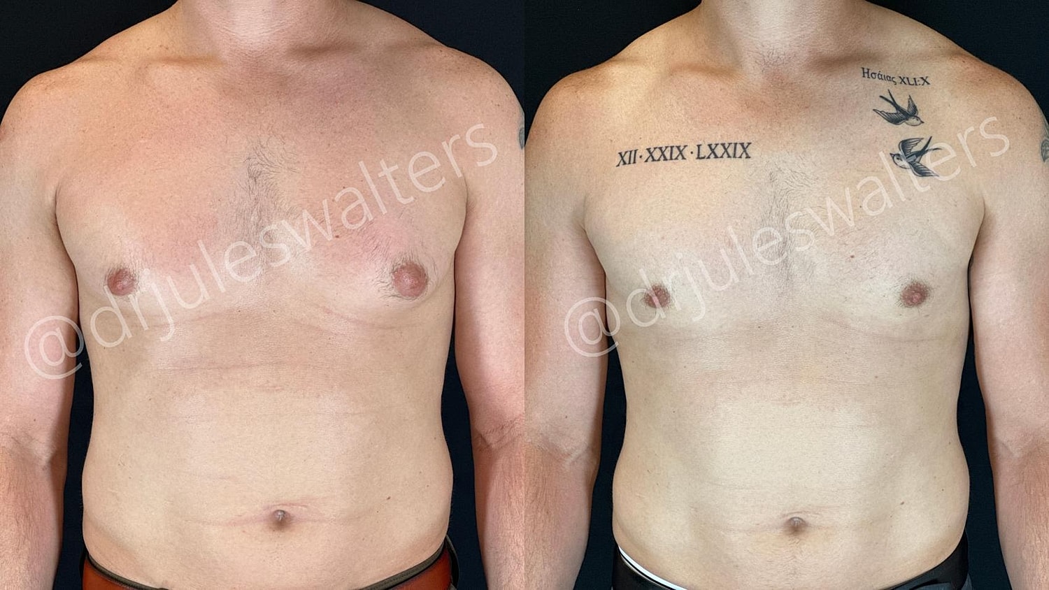 Gynecomastia Before & After