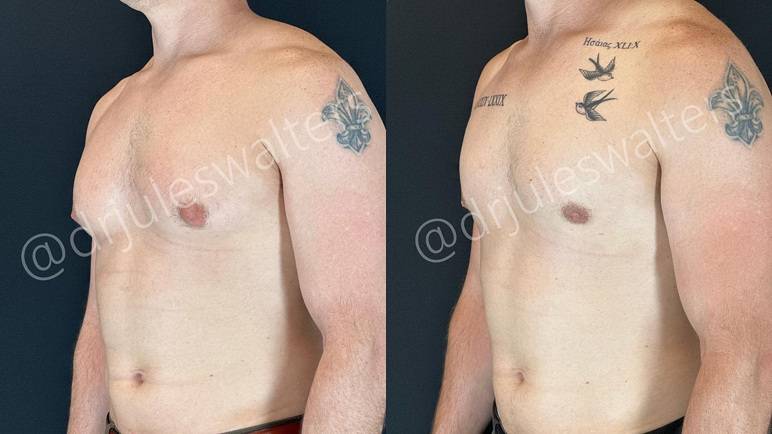 Gynecomastia Before & After