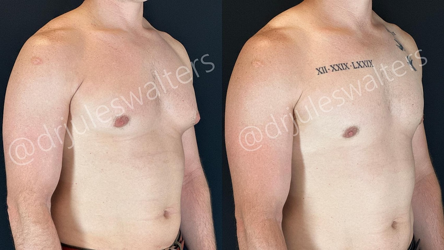 Gynecomastia Before & After