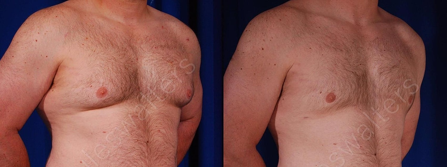 Gynecomastia Before & After