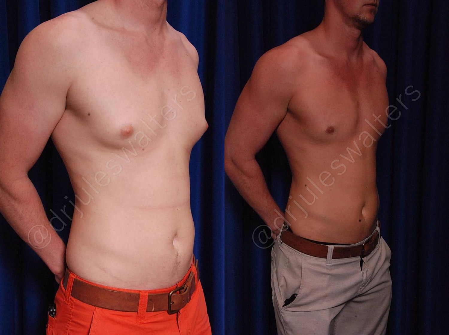 Gynecomastia Before & After