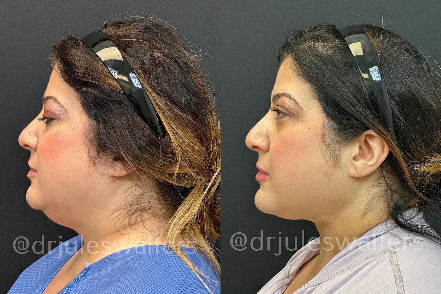 Vaserlipo Before & After