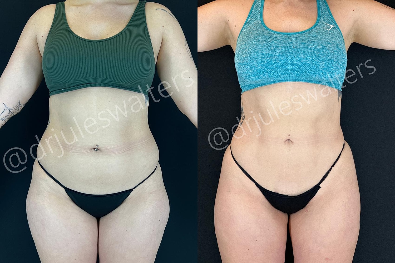 Vaserlipo Before & After