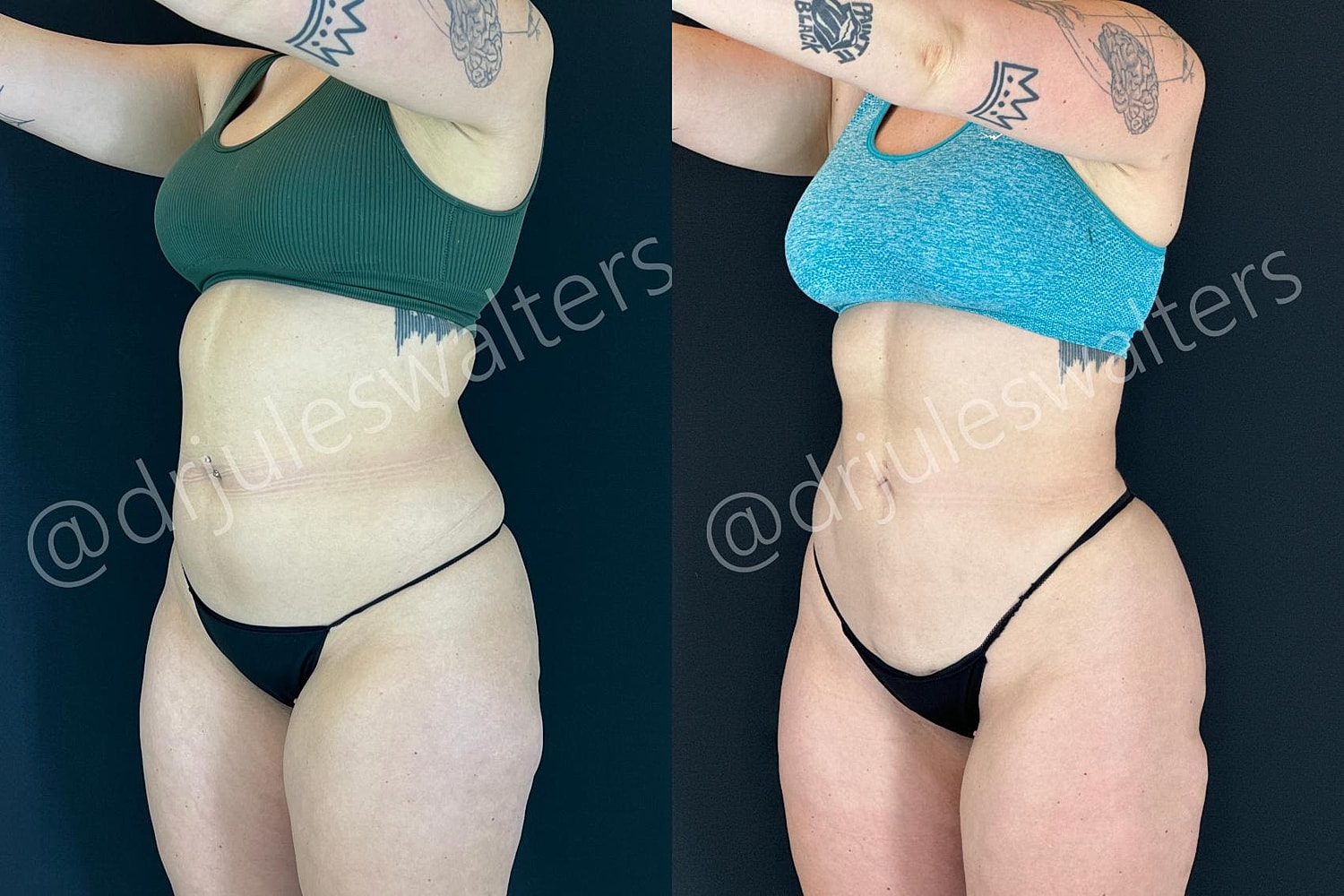 Vaserlipo Before & After