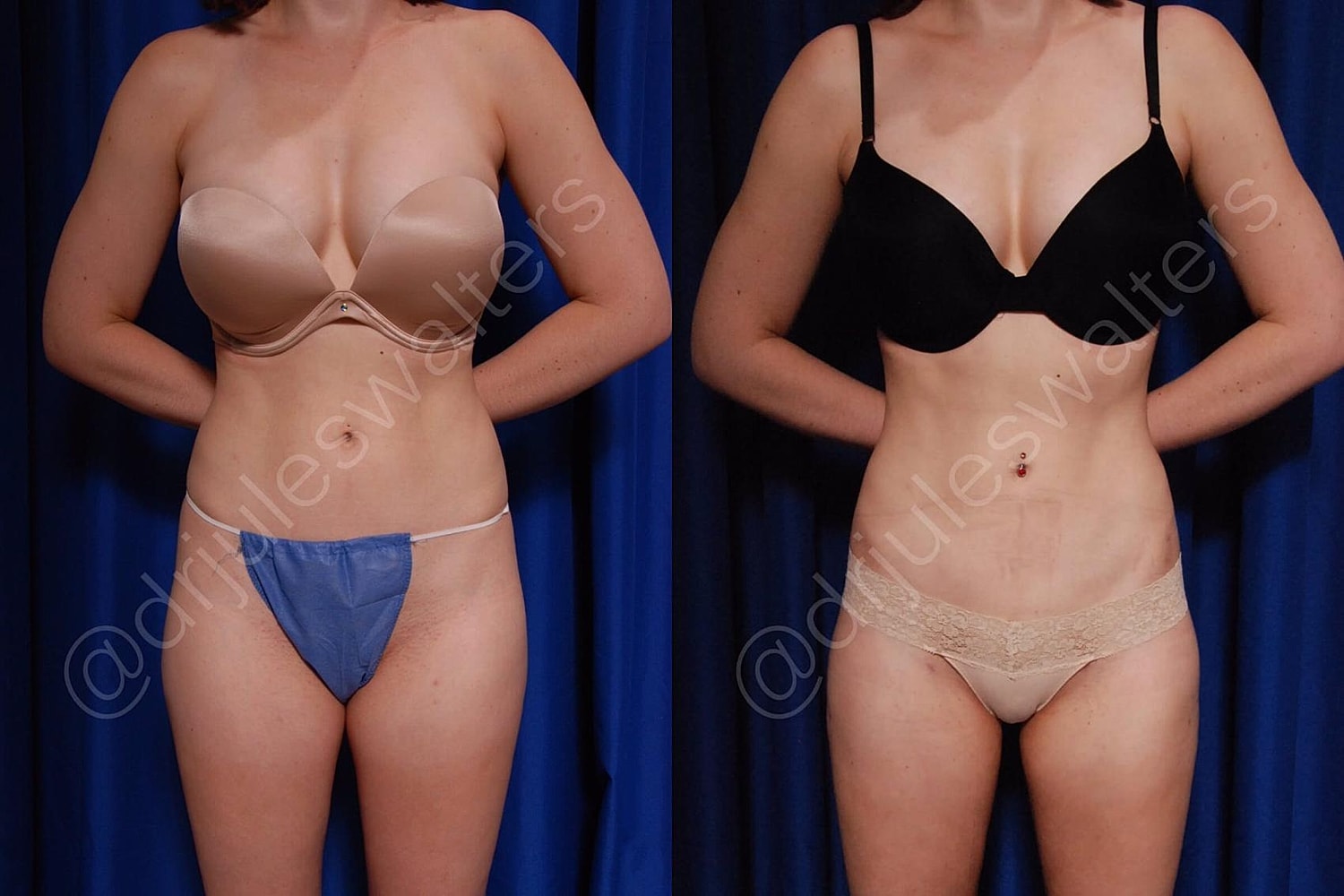 Vaserlipo Before & After