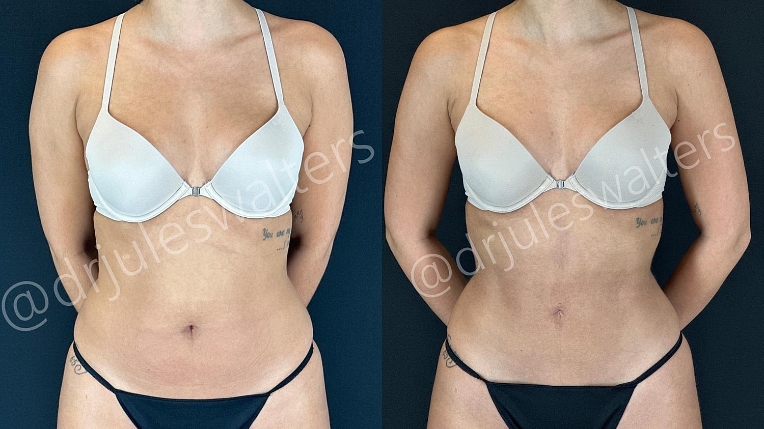 Vaserlipo Before & After