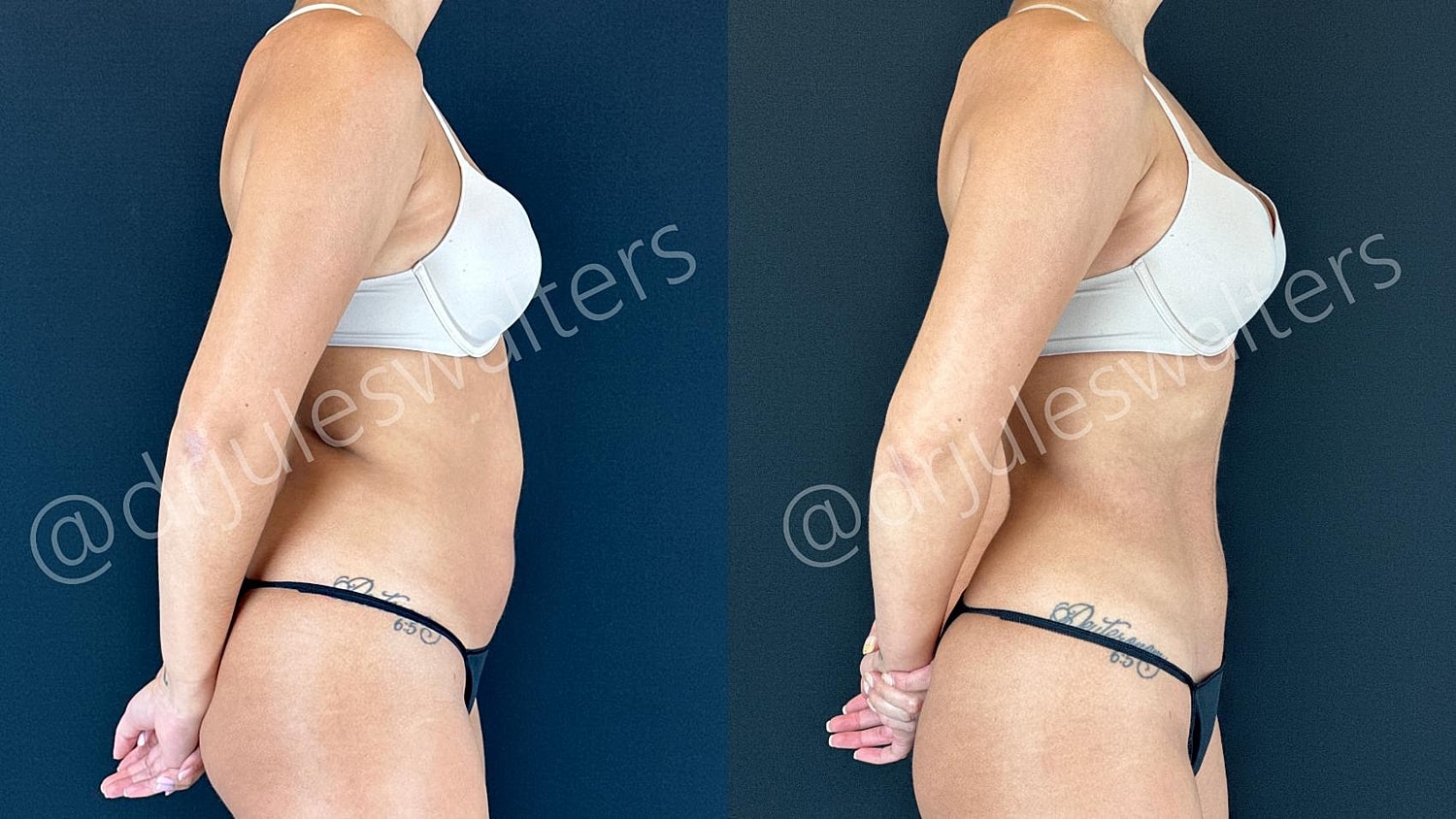 Vaserlipo Before & After
