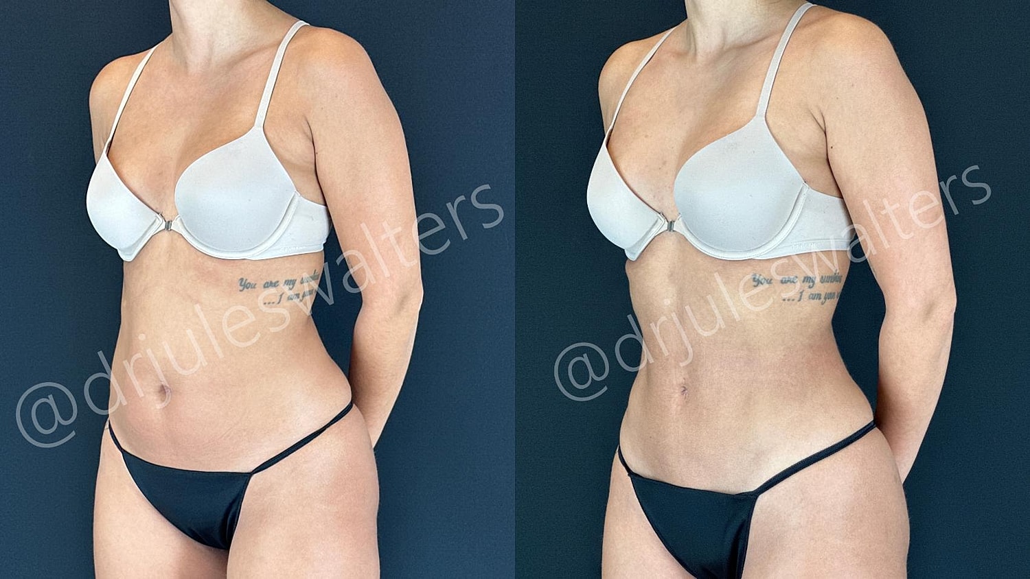 Vaserlipo Before & After