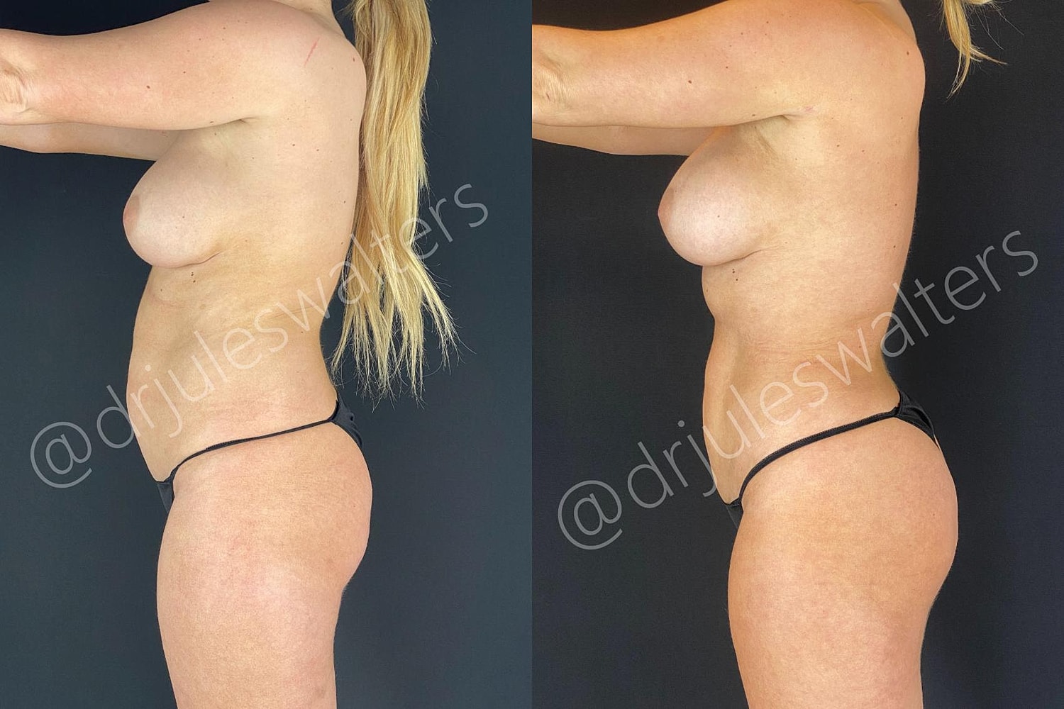 Vaserlipo Before & After