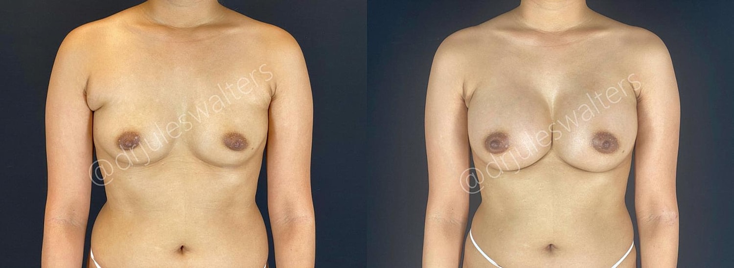 Vaserlipo Before & After