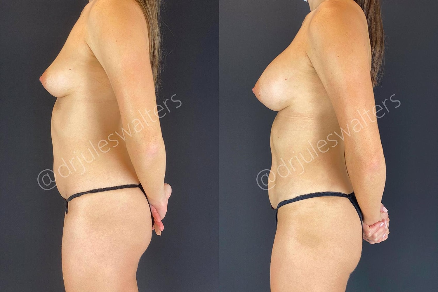 Vaserlipo Before & After
