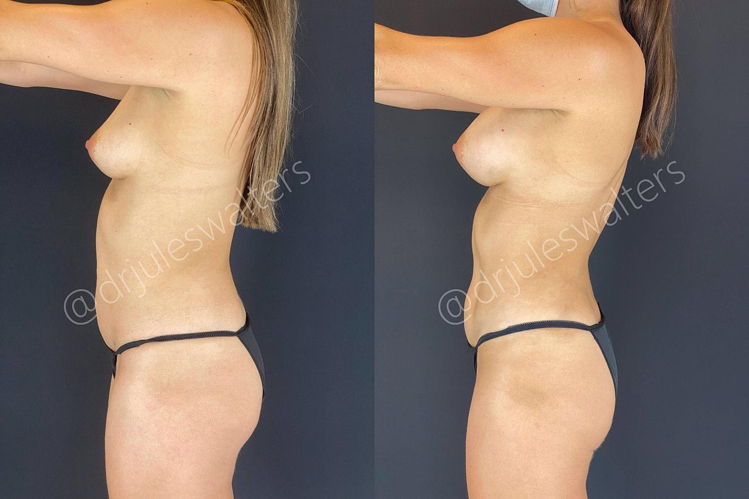 Vaserlipo Before & After