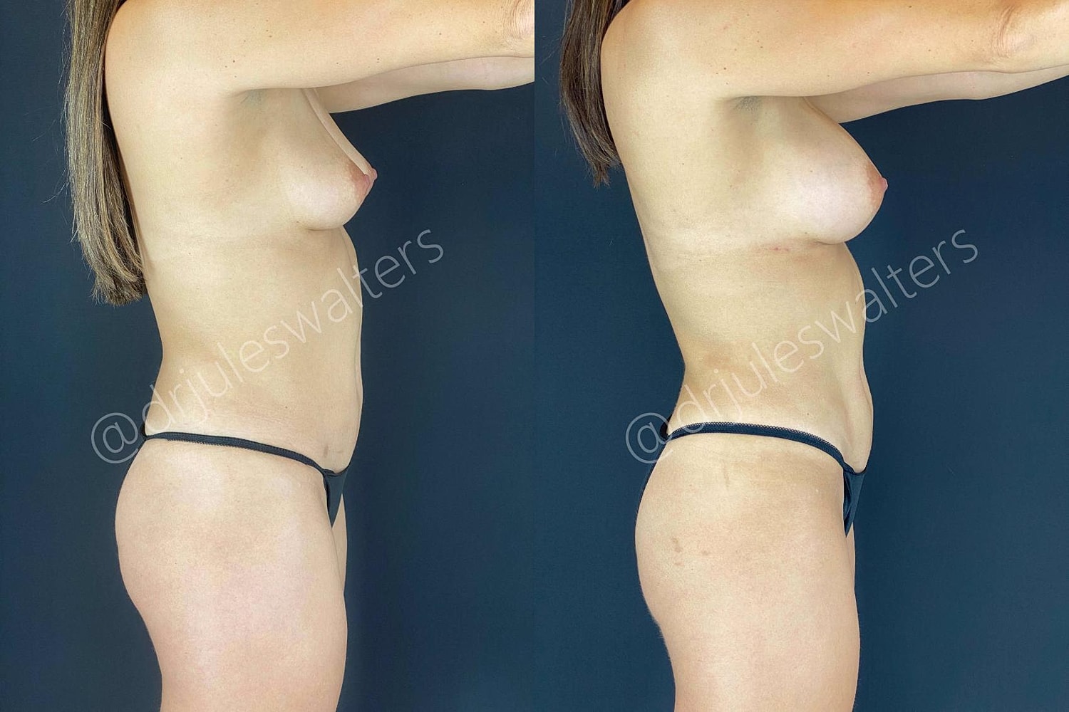 Vaserlipo Before & After