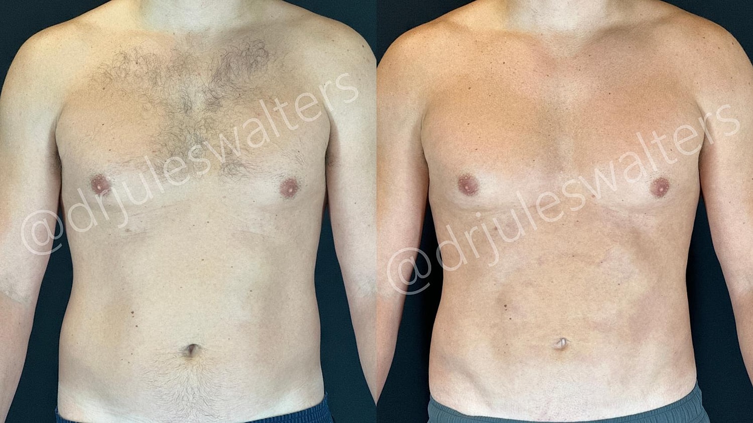 Vaserlipo Before & After