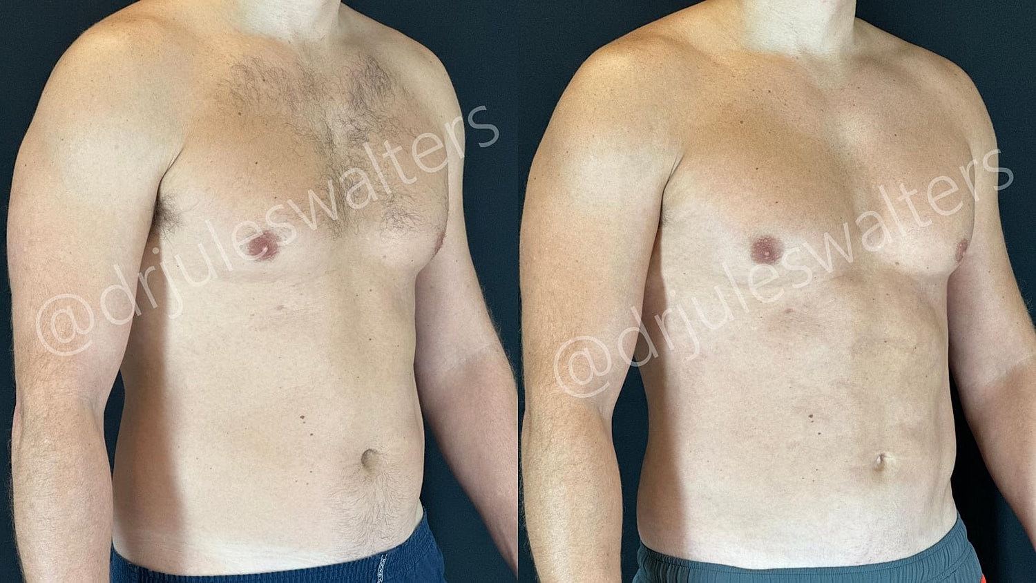 Vaserlipo Before & After