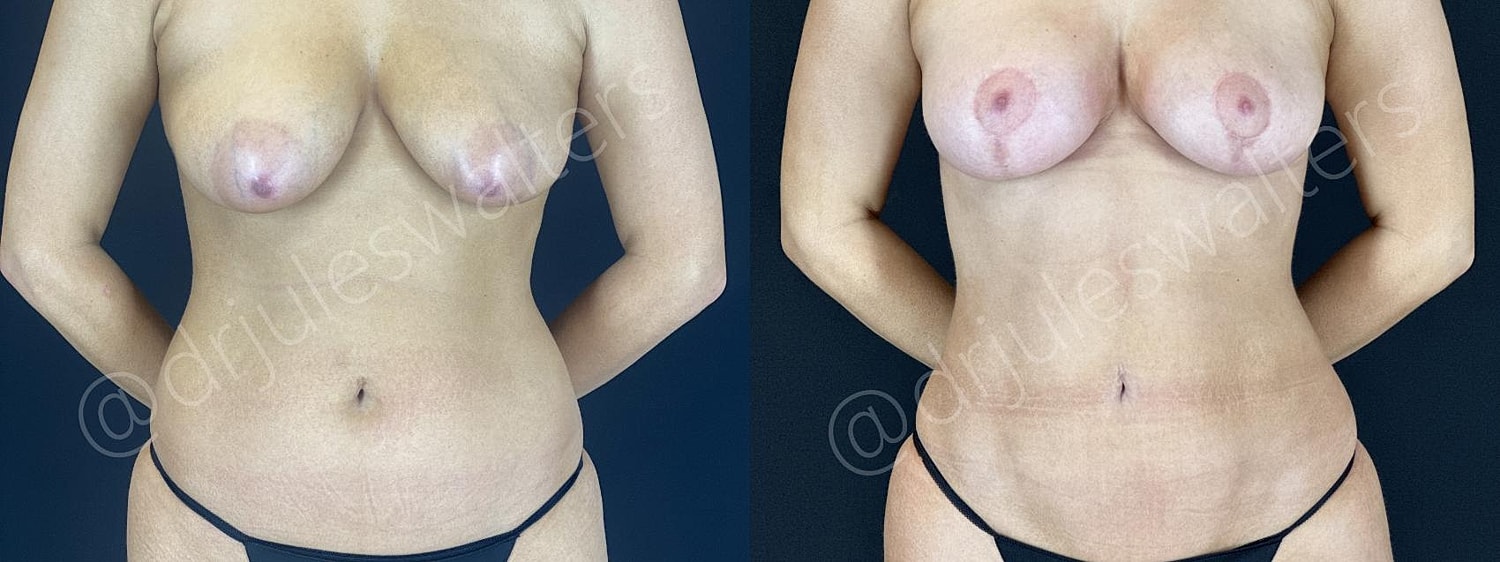Vaserlipo Before & After