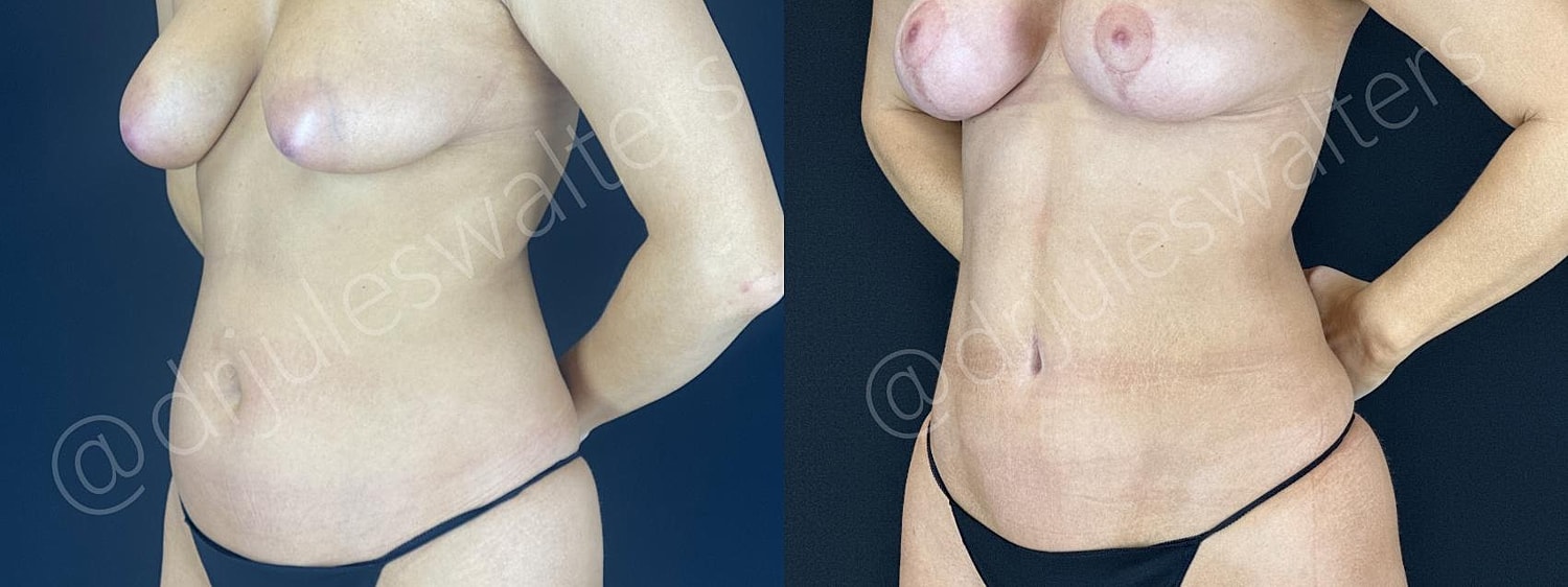 Vaserlipo Before & After