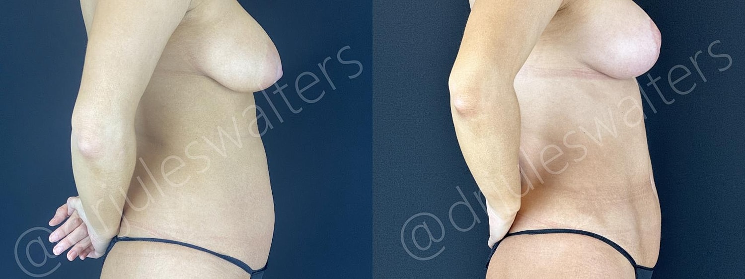 Vaserlipo Before & After