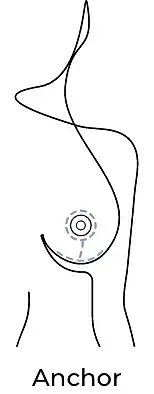 Anchor breast procedure illustration.