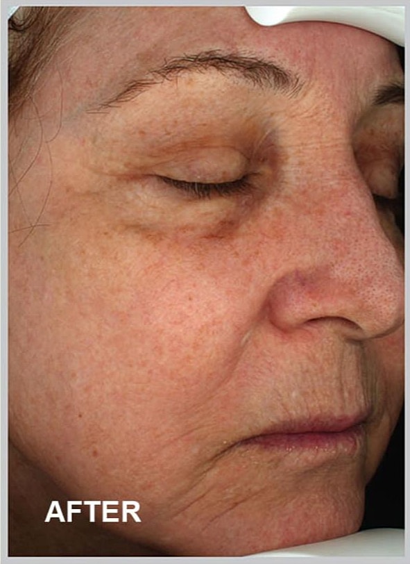 Improved skin appearance after treatment procedure.