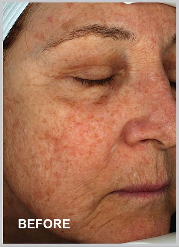 Before skin treatment, showing signs of aging.