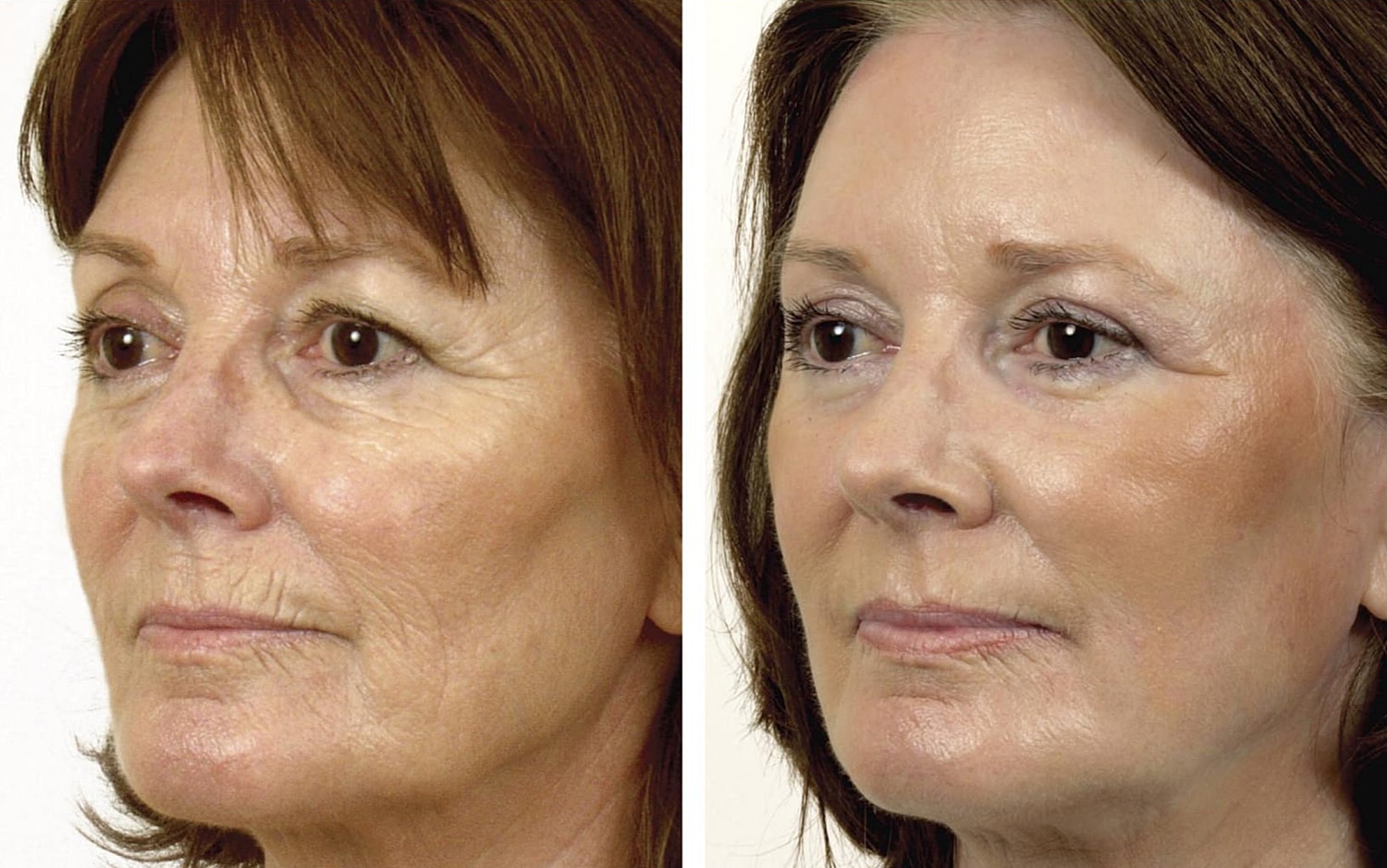 Before and after skin rejuvenation treatment photos.