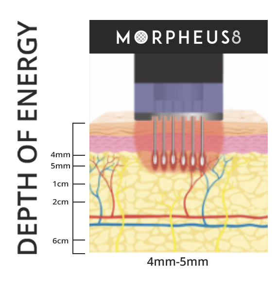 Morpheus8 penetrates 4 to 5 mm into the skin