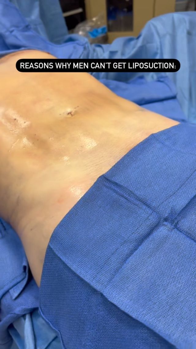 Actually, we couldn’t think of one. Liposuction is for everyone! 

This patient came to us desiring more definition in his abdomen. With the help of Dr. Walters hi-def liposuction techniques, he got just that!

#beforeandafter #immediateresults #VASERlipo #hidefliposuction #maleplasticsurgery #maleliposuction #liposuction #summerready #tonedtummy #hillsandvalleys #lookgoodfeelgood #lipo