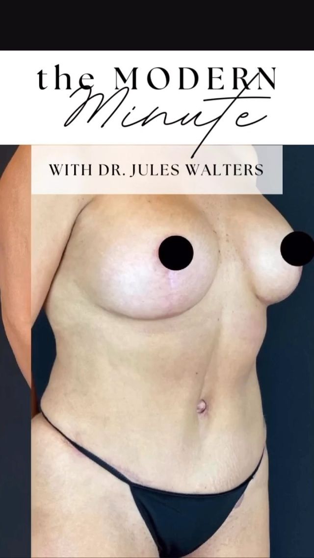 𝘁𝗵𝗲 M O D E R N 𝗠𝗶𝗻𝘂𝘁𝗲

In this week’s episode, Dr. Jules Walters discusses the recovery of a tummy tuck with liposuction. 

If you have any questions, feel free to send us a message!

#themodern #modernizingbeauty #drjuleswalters #themoderndifference #plasticsurgeon #metairiesurgeon #metairieplasticsurgery #louisianasurgeon #louisianaplasticsurgery
