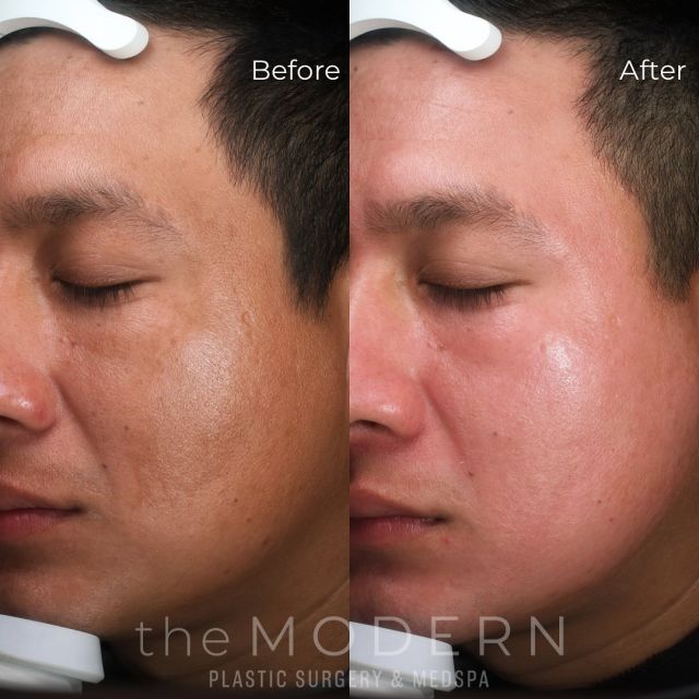 This patient has only been seeing Robin for one month and he is already starting to see drastic improvement to the melasma, tone & texture of his skin! 

#themodern #modernizingbeauty #drjuleswalters #themoderndifference #plasticsurgery #medspa #plasticsurgeon #metairiesurgeon #metairieplasticsurgery #louisianasurgeon #louisianaplasticsurgery #sunscreen #skinhealth #sunscreeneveryday #resultsmatter #protectedskin #antiaging #melasma #visia
