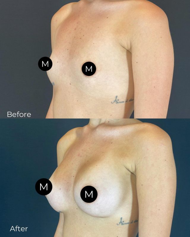 The difference a couple of implants can make! This patient’s confidence skyrocketed after her rapid recovery breast augmentation! 👏

#themodern #modernizingbeauty #drjuleswalters #themoderndifference #plasticsurgeon #metairiesurgeon #metairieplasticsurgery #louisianasurgeon #louisianaplasticsurgery
#breastaugmentation #breastaug #gummybearimplants #siliconeimplants #fullbreasts #breastsurgery #beforeandafter #breastrevision #smallbreasts #rapidrecoverybreastaugmentation